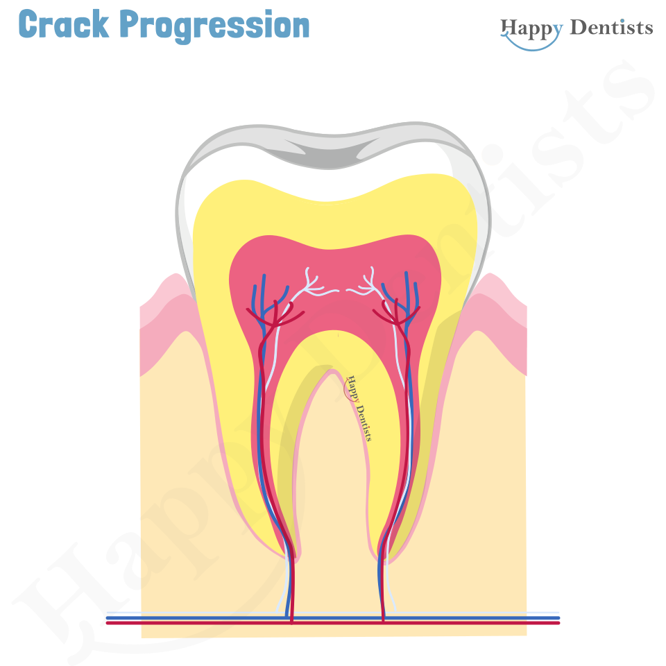 Crack tooth, Tooth Crack Animation